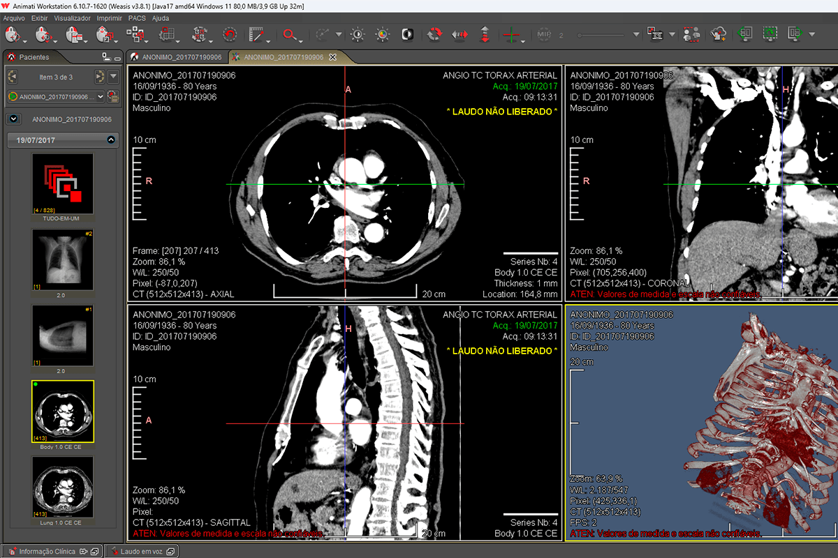 Tela do Animati Workstation com reconstrução multiplanar MPR e renderização 3D de tomografia computadorizada para radiologista